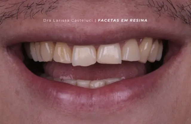 Sorriso antes da transformação 02