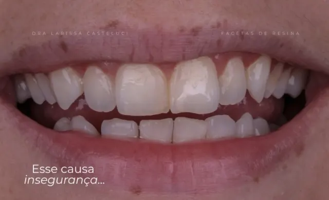 Sorriso antes da transformação 03
