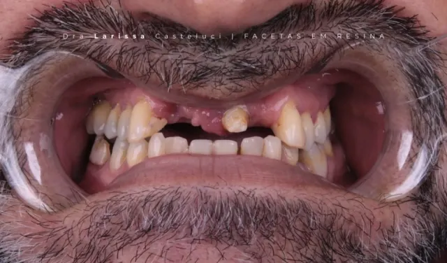 Sorriso antes da transformação 04